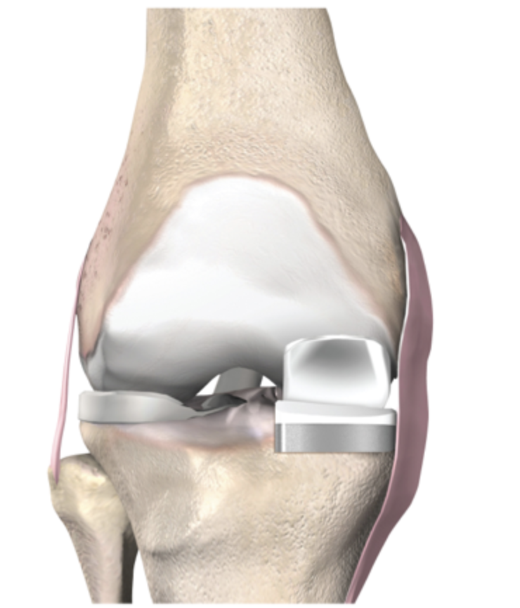 Protesi monocompartimentale di ginocchio: