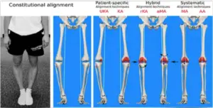 Schema riassuntivo dei possibili allineamenti del ginocchio | Dr. Franco Baldo