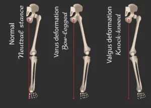 Deformazioni ginocchio in varo e in valgo | Dr. Franco Baldo