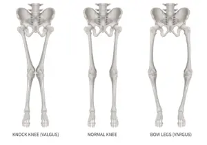 Schema dell'allineamento cinematico delle ginocchia | Dr. Franco Baldo