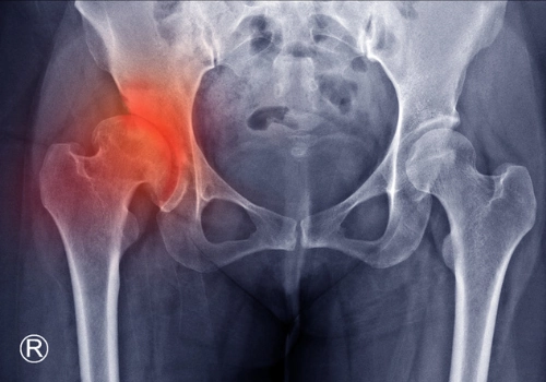 Radiografia che evidenzia la zona di dolore da displasia all'anca